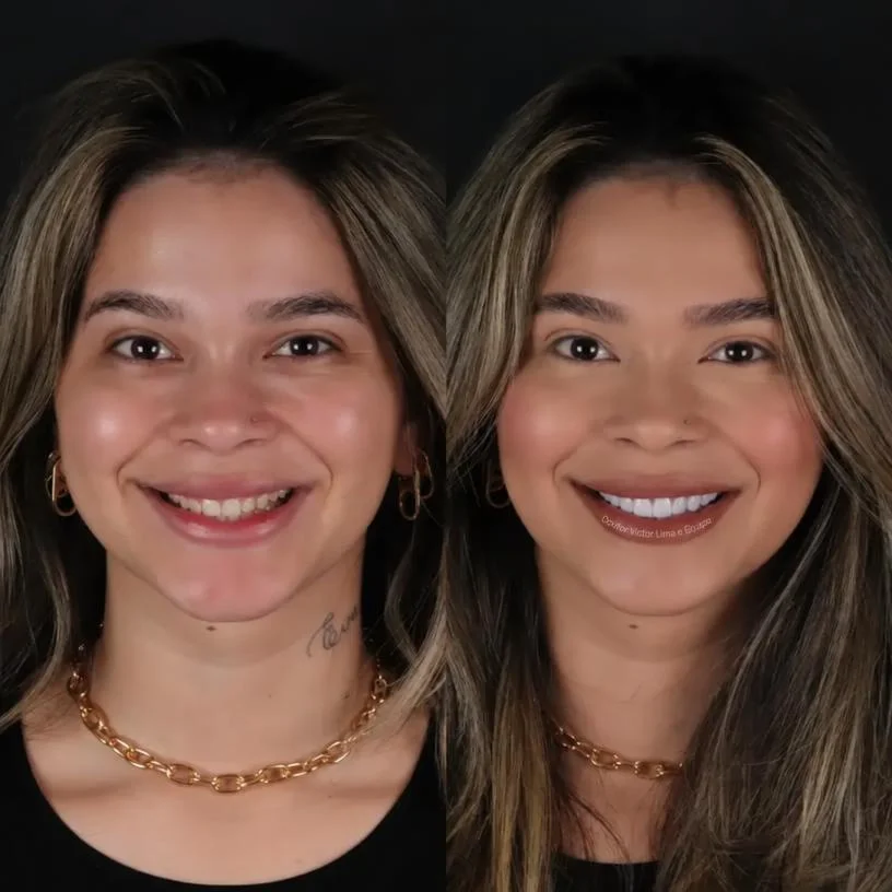 Antes e depois — resultado inicial